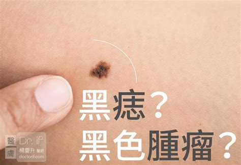 身體長痣的原因|痣是什麼？會變成黑色素瘤？7種一定要除的痣